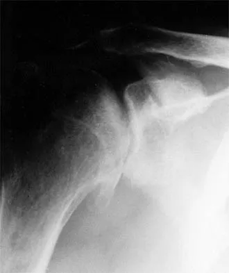 Shoulder 2026 MCQs: Board Review Questions & Answers (Part 1) - Figure 3