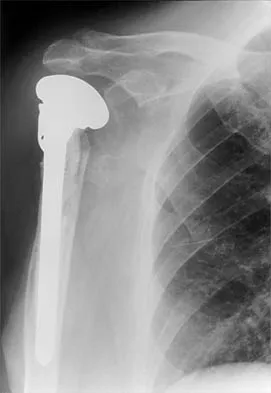 Shoulder 2026 MCQs: Board Review Questions & Answers (Part 2) - Figure 59