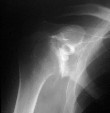 Shoulder 2026 MCQs: Board Review Questions & Answers (Part 2) - Figure 65