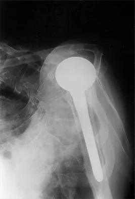 Shoulder 2026 MCQs: Board Review Questions & Answers (Part 2) - Figure 87