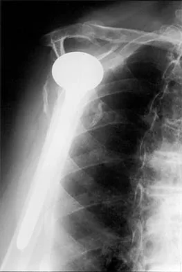 Shoulder 2026 MCQs: Board Review Questions & Answers (Part 3) - Figure 33