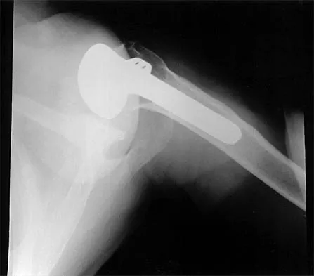 Shoulder 2026 MCQs: Board Review Questions & Answers (Part 4) - Figure 13