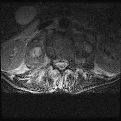 Spine 2026 MCQs: Board Review Questions & Answers (Part 1) - Figure 113