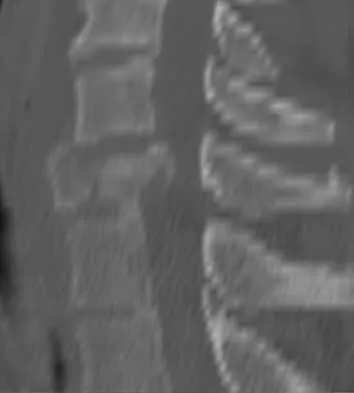 Spine 2026 MCQs: Board Review Questions & Answers (Part 1) - Figure 139