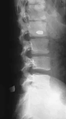 Spine 2026 MCQs: Board Review Questions & Answers (Part 1) - Figure 143