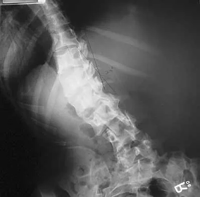 Spine 2026 MCQs: Board Review Questions & Answers (Part 1) - Figure 43