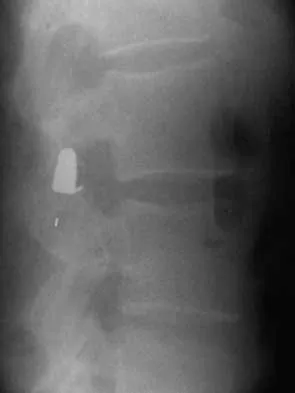 Spine 2026 MCQs: Board Review Questions & Answers (Part 1) - Figure 63