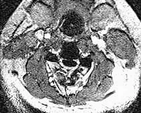 Spine 2026 MCQs: Board Review Questions & Answers (Part 2) - Figure 44