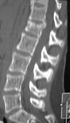 Spine 2026 MCQs: Board Review Questions & Answers (Part 3) - Figure 19