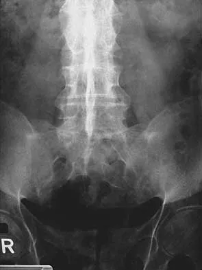 Orthopedic Spine 2026 MCQs (Part 4): Deformity, Trauma & Degenerative Conditions | AAOS & ABOS Board Review