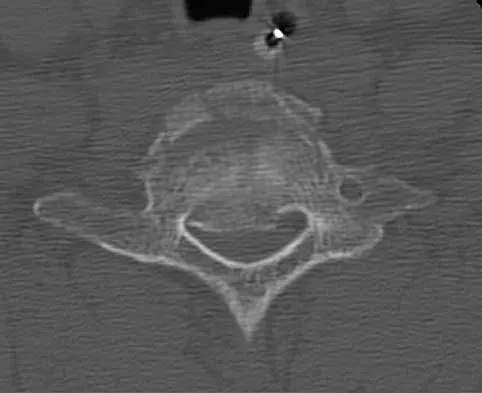 Spine Surgery 2000 Practice Questions: Set 1 (Solved) - Figure 11