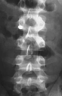 Spine Surgery 2000 Practice Questions: Set 1 (Solved) - Figure 35