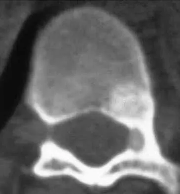 Spine Surgery Board Review 2000: High-Yield MCQs (Set 2) - Figure 28