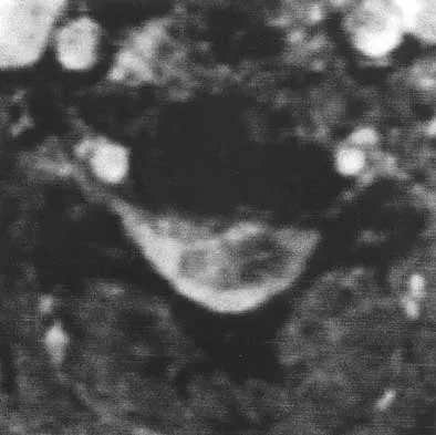 Spine Surgery Board Review 2000: High-Yield MCQs (Set 4) - Figure 3