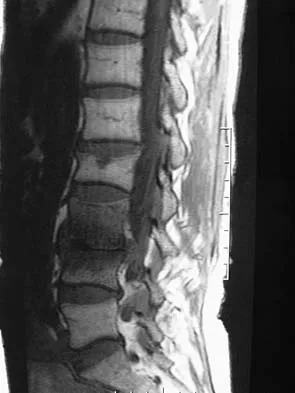 Spine Surgery 2006 Practice Questions: Set 1 (Solved) - Figure 2