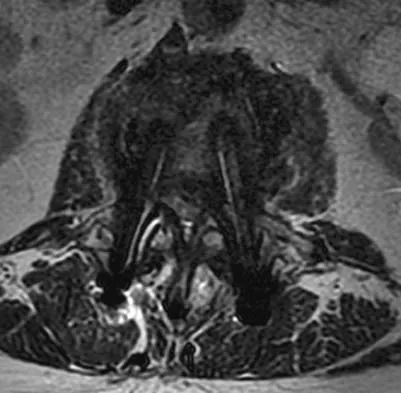 Spine Surgery Board Review 2006: High-Yield MCQs (Set 2) - Figure 13