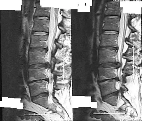 Spine Surgery Board Review 2006: High-Yield MCQs (Set 2) - Figure 3