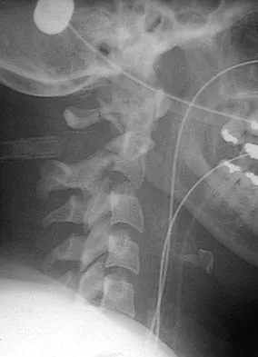 Spine 2006 MCQs - Part 3