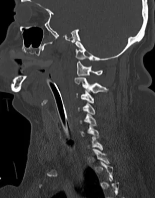 Spine Surgery 2009 Practice Questions: Set 1 (Solved) - Figure 16