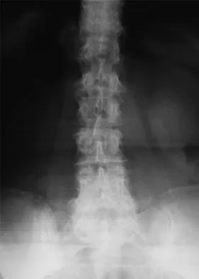 Spine Surgery 2009 Practice Questions: Set 1 (Solved) - Figure 19