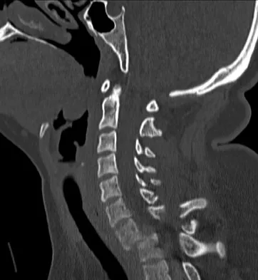 Spine Surgery 2009 Practice Questions: Set 1 (Solved) - Figure 22