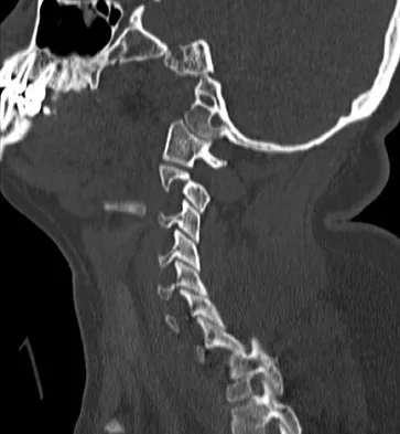 Spine Surgery 2009 Practice Questions: Set 1 (Solved) - Figure 23
