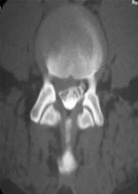 Spine Surgery 2009 Practice Questions: Set 1 (Solved) - Figure 3
