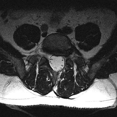 Spine Surgery 2009 Practice Questions: Set 1 (Solved) - Figure 6