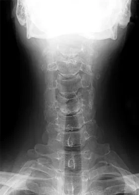 AAOS Spine Surgery MCQs (Set 2): Degenerative Cervical, Lumbar Disc, & Trauma | ABOS Review