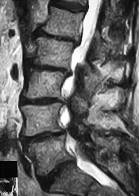 Spine Surgery Board Review 2009: High-Yield MCQs (Set 2) - Figure 20