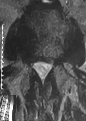 Spine Surgery Board Review 2009: High-Yield MCQs (Set 2) - Figure 21