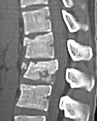 Spine Surgery Board Review 2009: High-Yield MCQs (Set 2) - Figure 34
