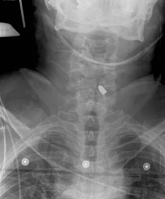 Spine Surgery Board Review 2009: High-Yield MCQs (Set 2) - Figure 6