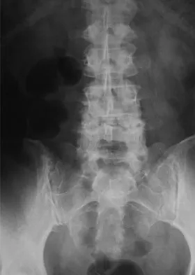AAOS & ABOS Spine Surgery MCQs (Set 3): Spinal Trauma, Degenerative Conditions, Scoliosis