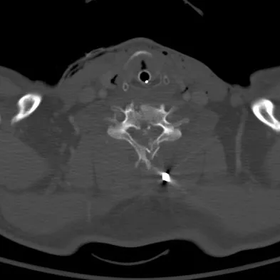 Spine Surgery 2009 Practice Questions: Set 3 (Solved) - Figure 17
