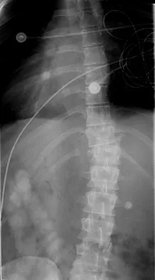 Spine Surgery Board Review 2009: High-Yield MCQs (Set 4) - Figure 3
