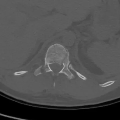 Spine Surgery Board Review 2009: High-Yield MCQs (Set 4) - Figure 4