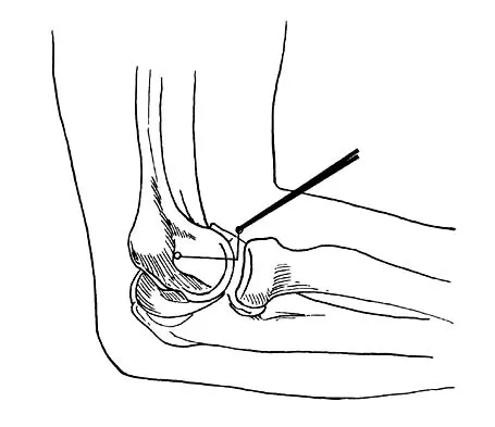 Sports Medicine Board Review 2001: High-Yield MCQs (Set 4) - Figure 3