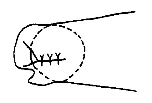 Sports Medicine 2004 Practice Questions: Set 1 (Solved) - Figure 13