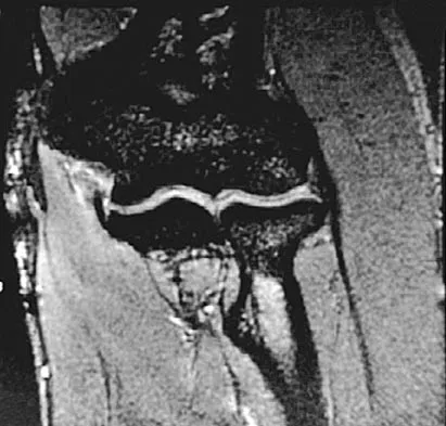 Sports Medicine Board Review 2004: High-Yield MCQs (Set 2) - Figure 15
