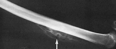 Sports Medicine Board Review 2004: High-Yield MCQs (Set 2) - Figure 3