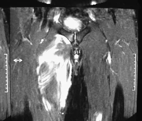 Sports Medicine Board Review 2007: High-Yield MCQs (Set 2) - Figure 4