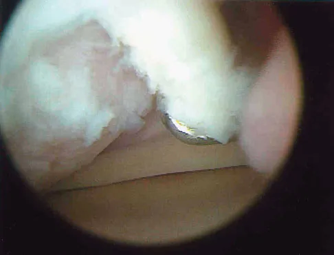 Sports Medicine Board Review 2007: High-Yield MCQs (Set 2) - Figure 5