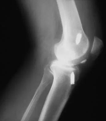 Sports Medicine Board Review 2007: High-Yield MCQs (Set 4) - Figure 4