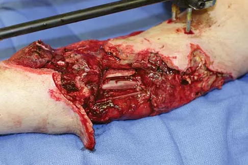 Trauma Board Review 2006: High-Yield MCQs (Set 2) - Figure 9