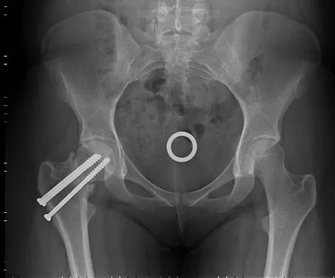 AAOS Orthopedic Trauma MCQs (Set 1): Acute Fracture & Emergency Care | ABOS & OITE Review