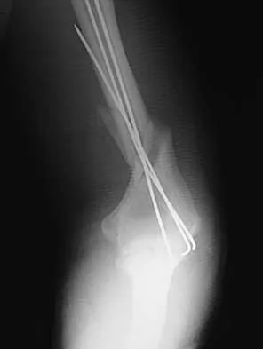 Trauma 2026 MCQs: Board Review Questions & Answers (Part 1) - Figure 85