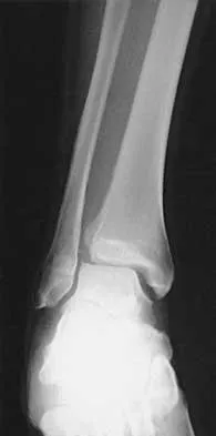 AAOS/ABOS Orthopedic Trauma MCQs (Part 4): Lower Extremity & Polytrauma Management | 2026 Board Review