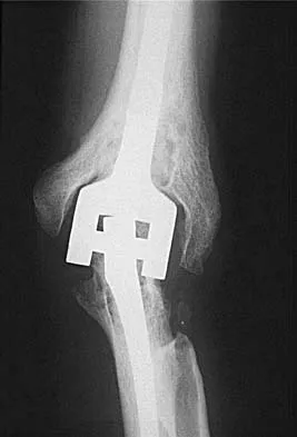 Upper Extremity 2005 Practice Questions: Set 1 (Solved) - Figure 14