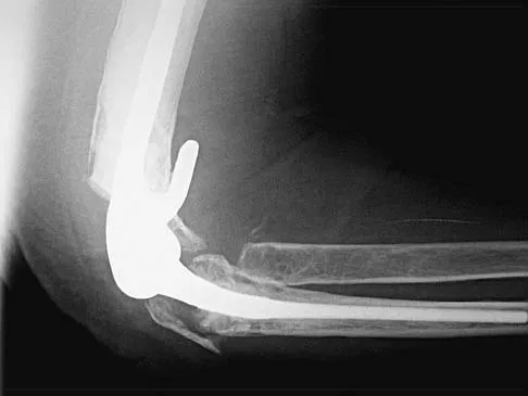 Upper Extremity Board Review 2005: High-Yield MCQs (Set 2) - Figure 11